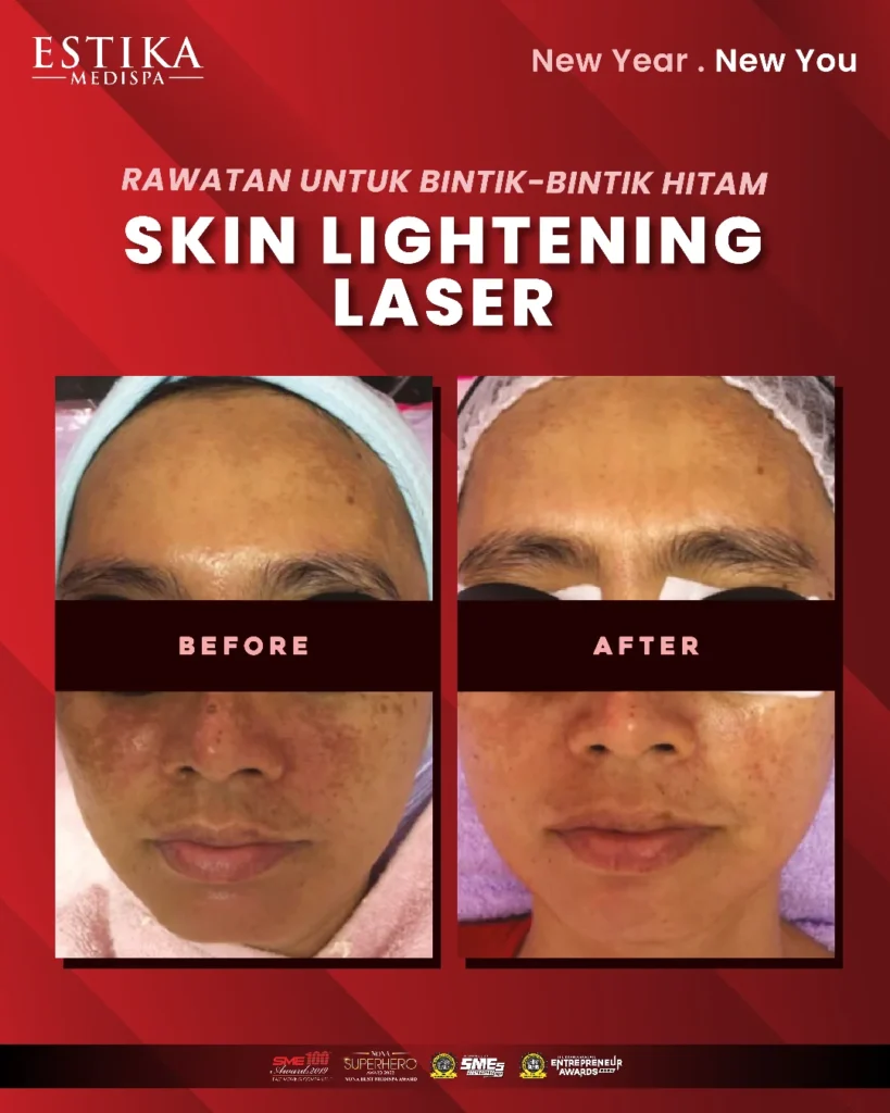 Before & After: Customer yang berjaya hilangkan jeragat muka di Estika Medispa