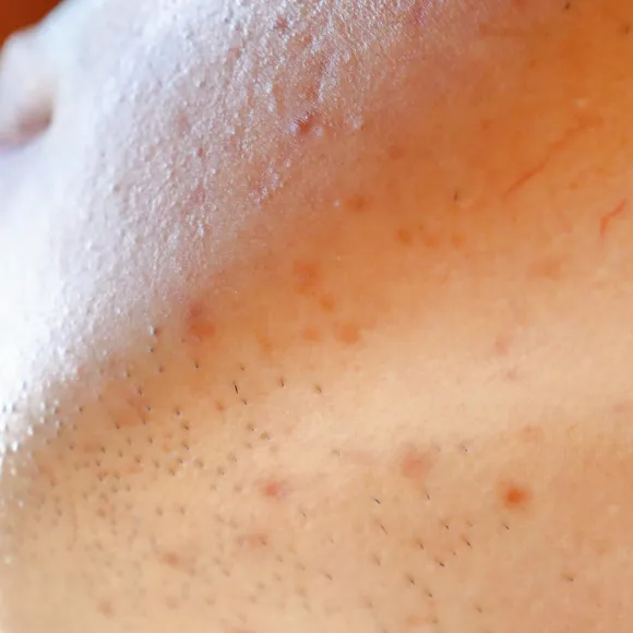 acne scar skin problem