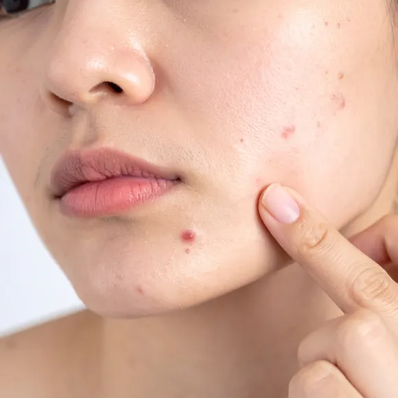 acne skin problem