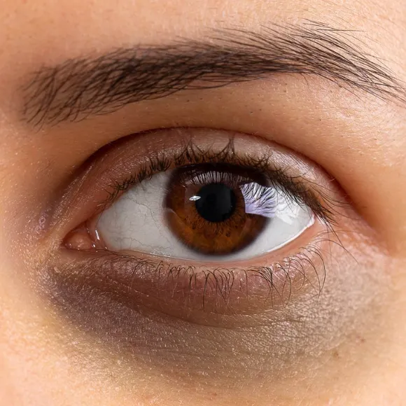 dark circle eye problem