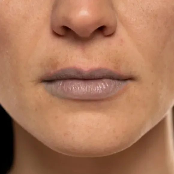 dark dry lips problem