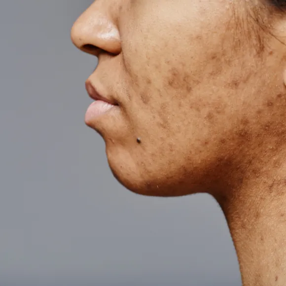 dark spot pigmentation problem