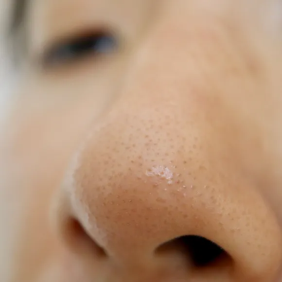 open pore skin problem