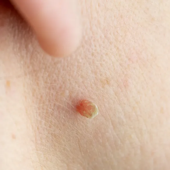 skin tag problem