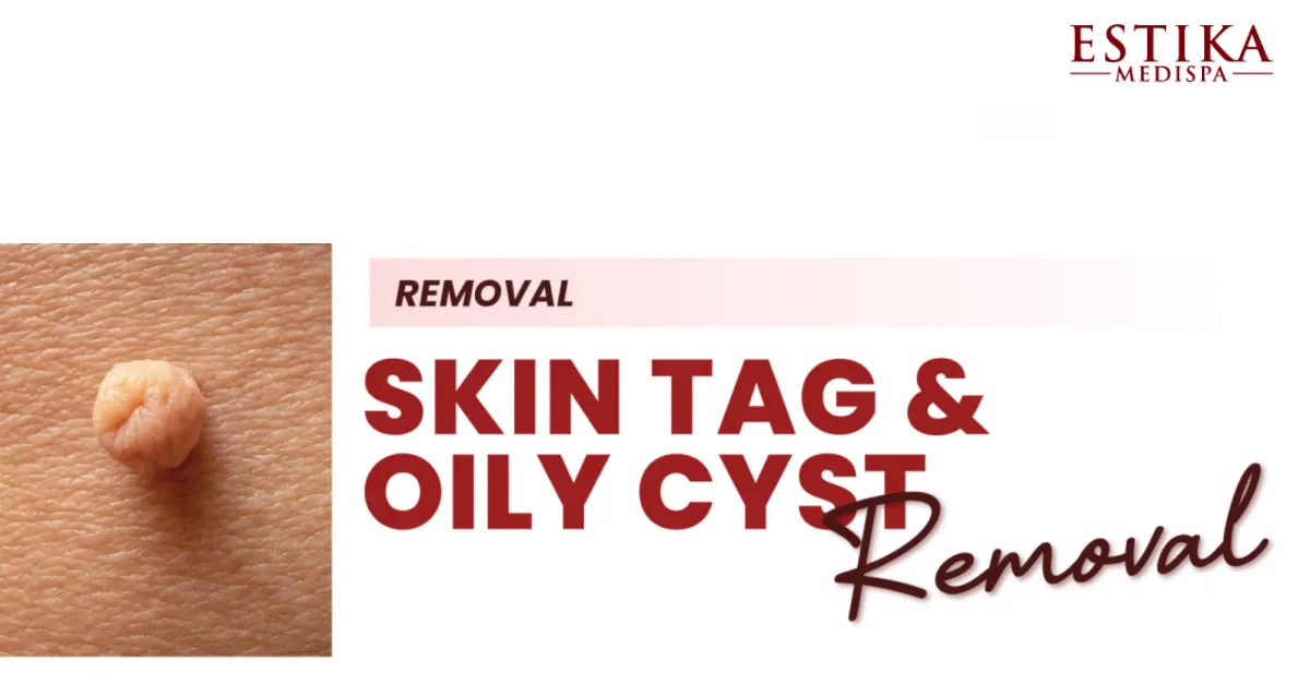 skin tag removal