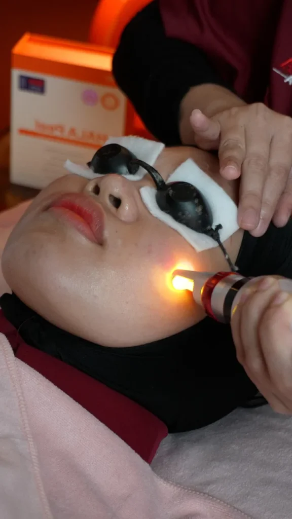 acne k-light treatment