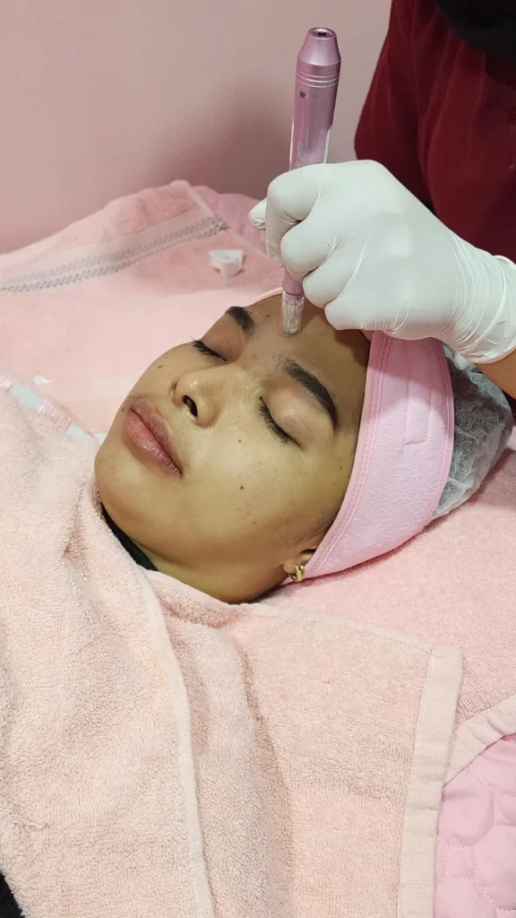 dermapen therapy