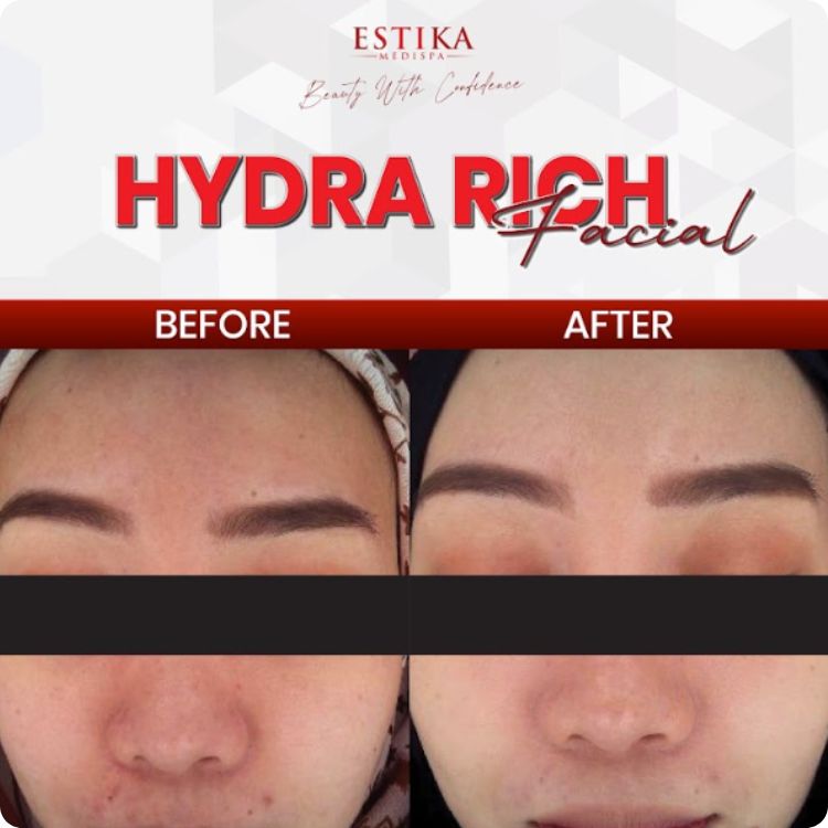 hydra facial