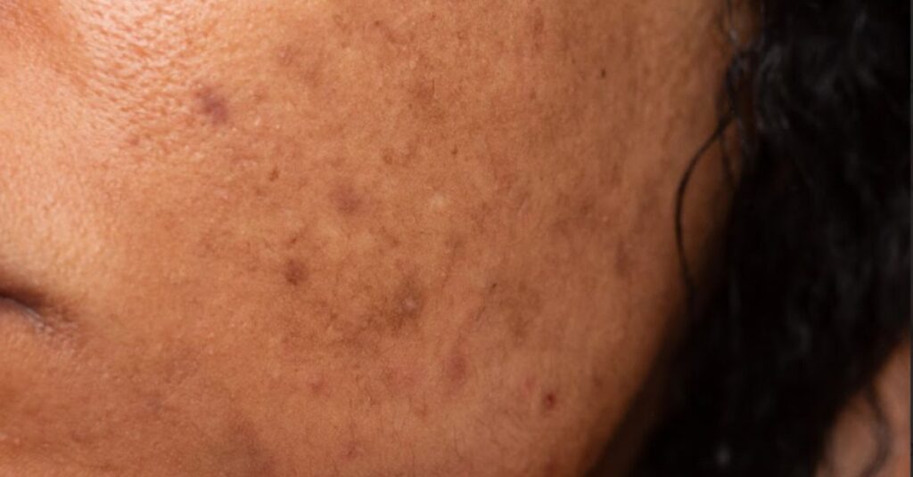 hydra facial