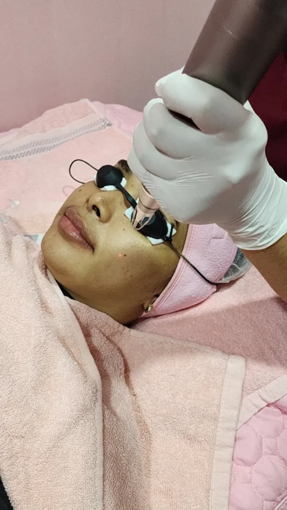 mole remover