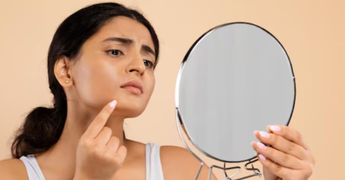 Estika Medispa face skin problem