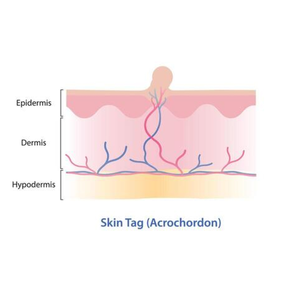 mole removal skin estika medispa