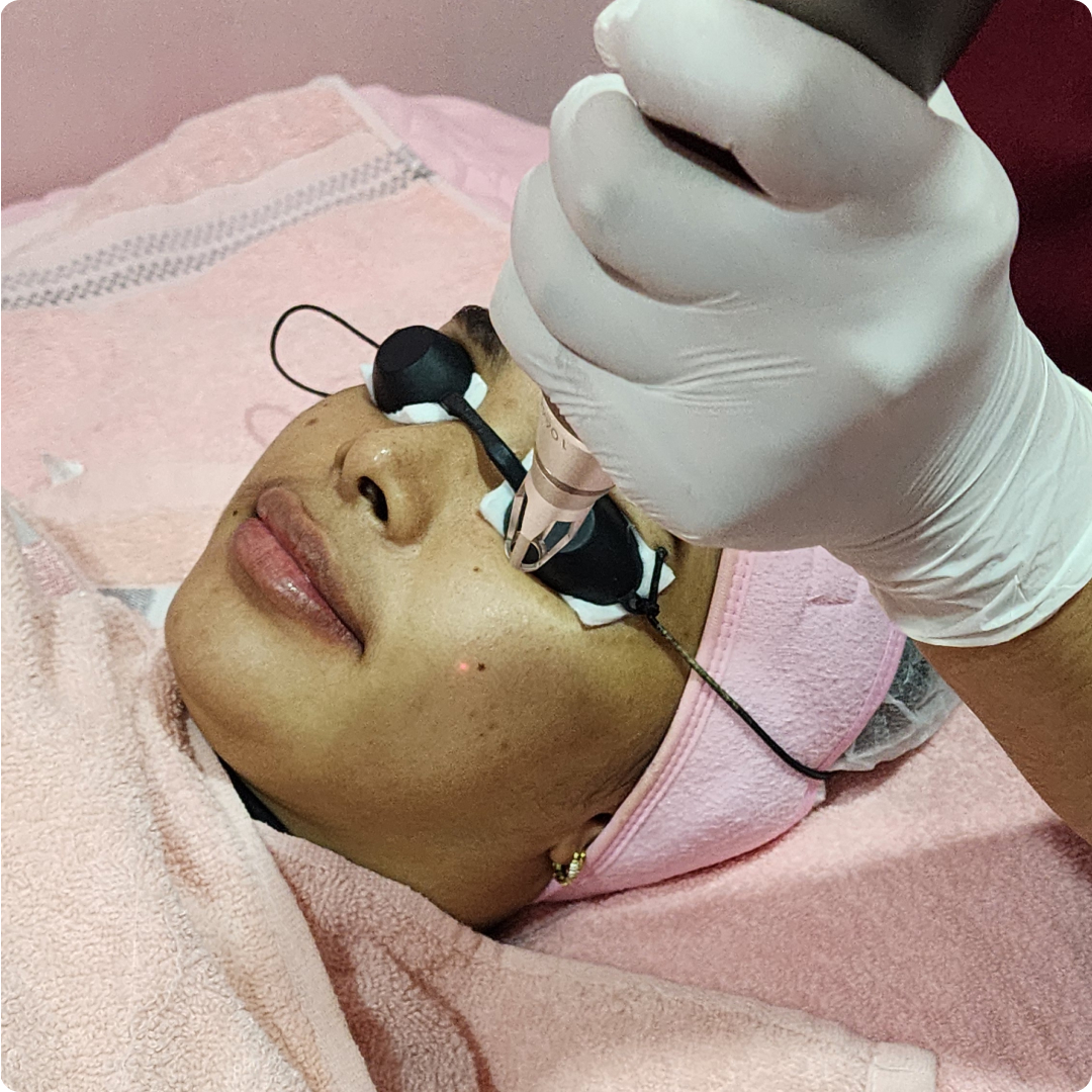 mole removal skin estika medispa