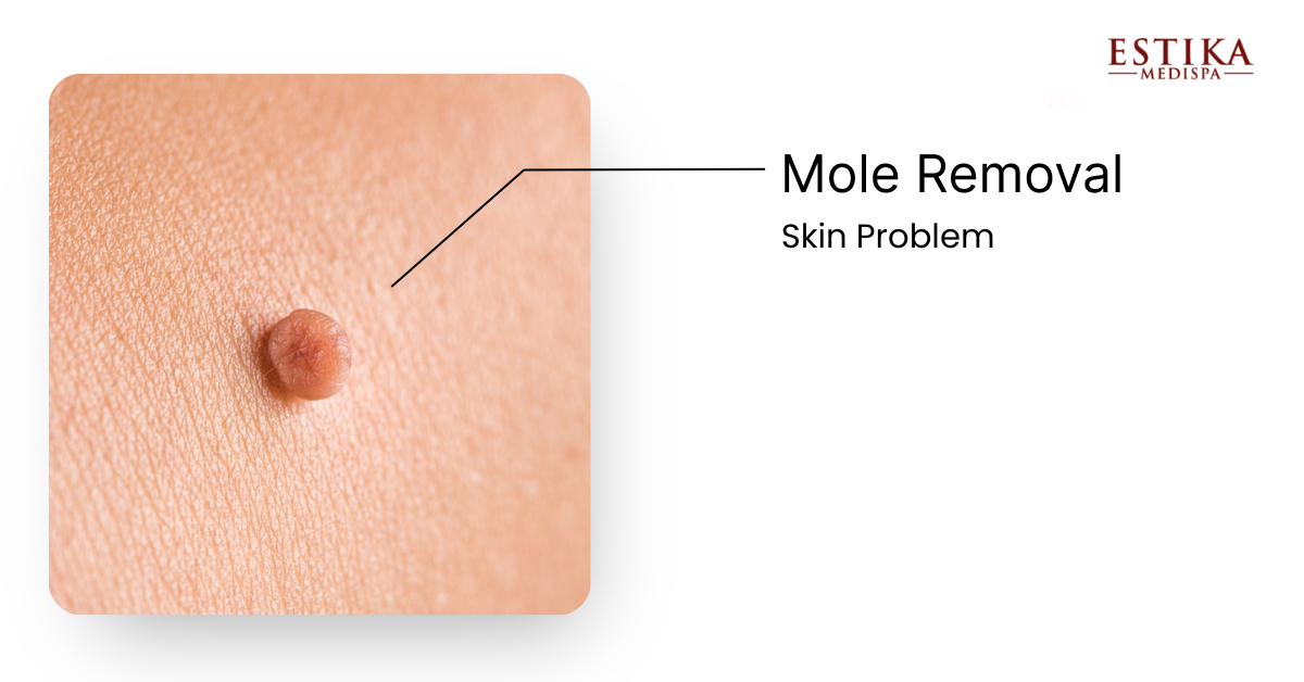 mole removal skin estika medispa