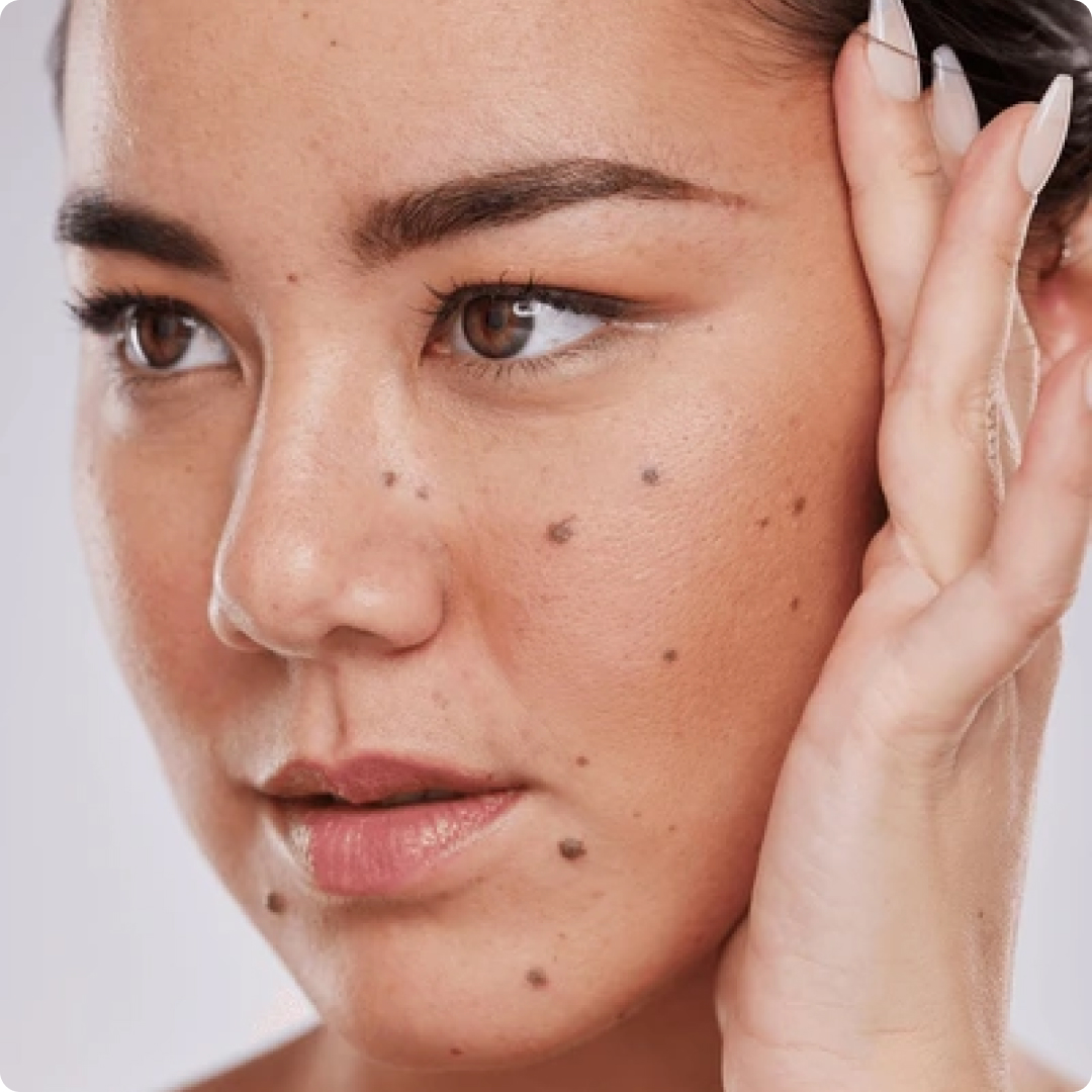 mole removal skin estika medispa