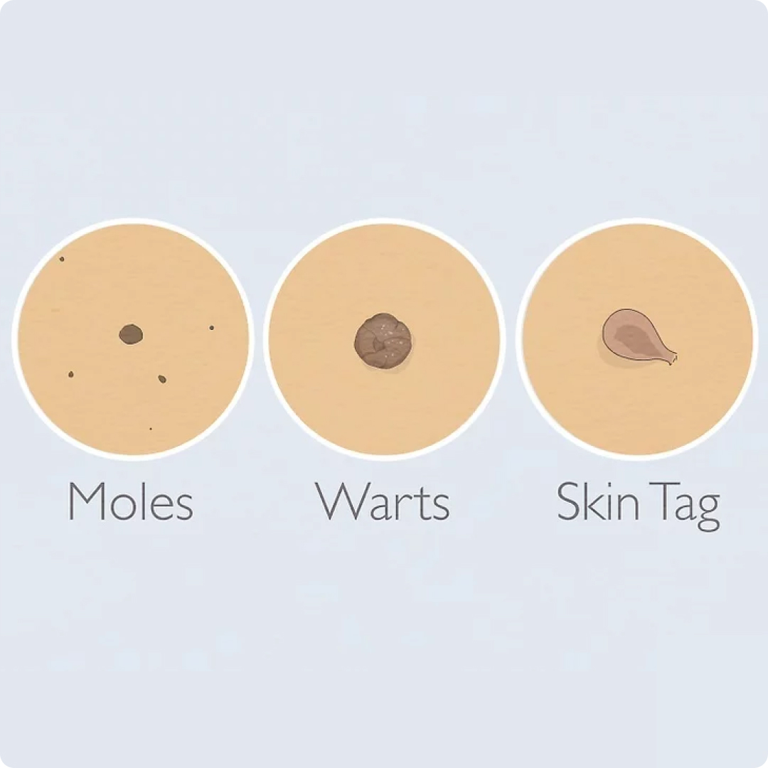 moles, warts, skin tag 