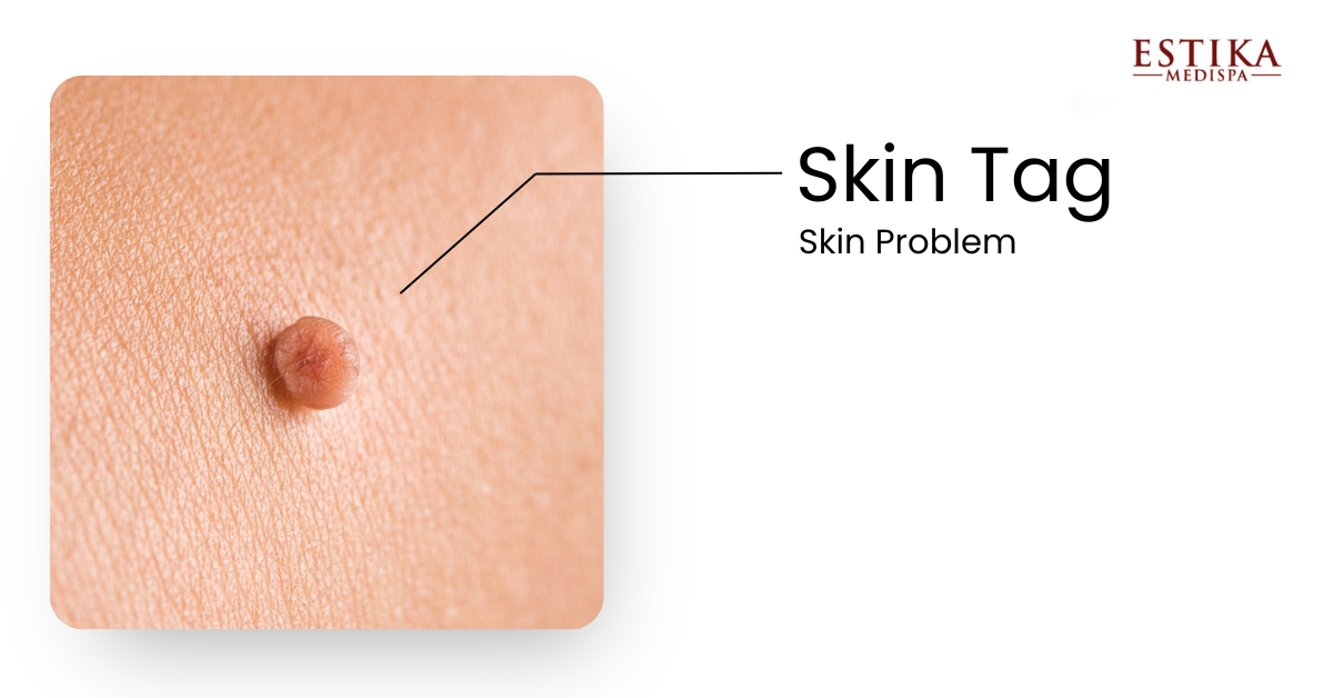 skin tag removal 