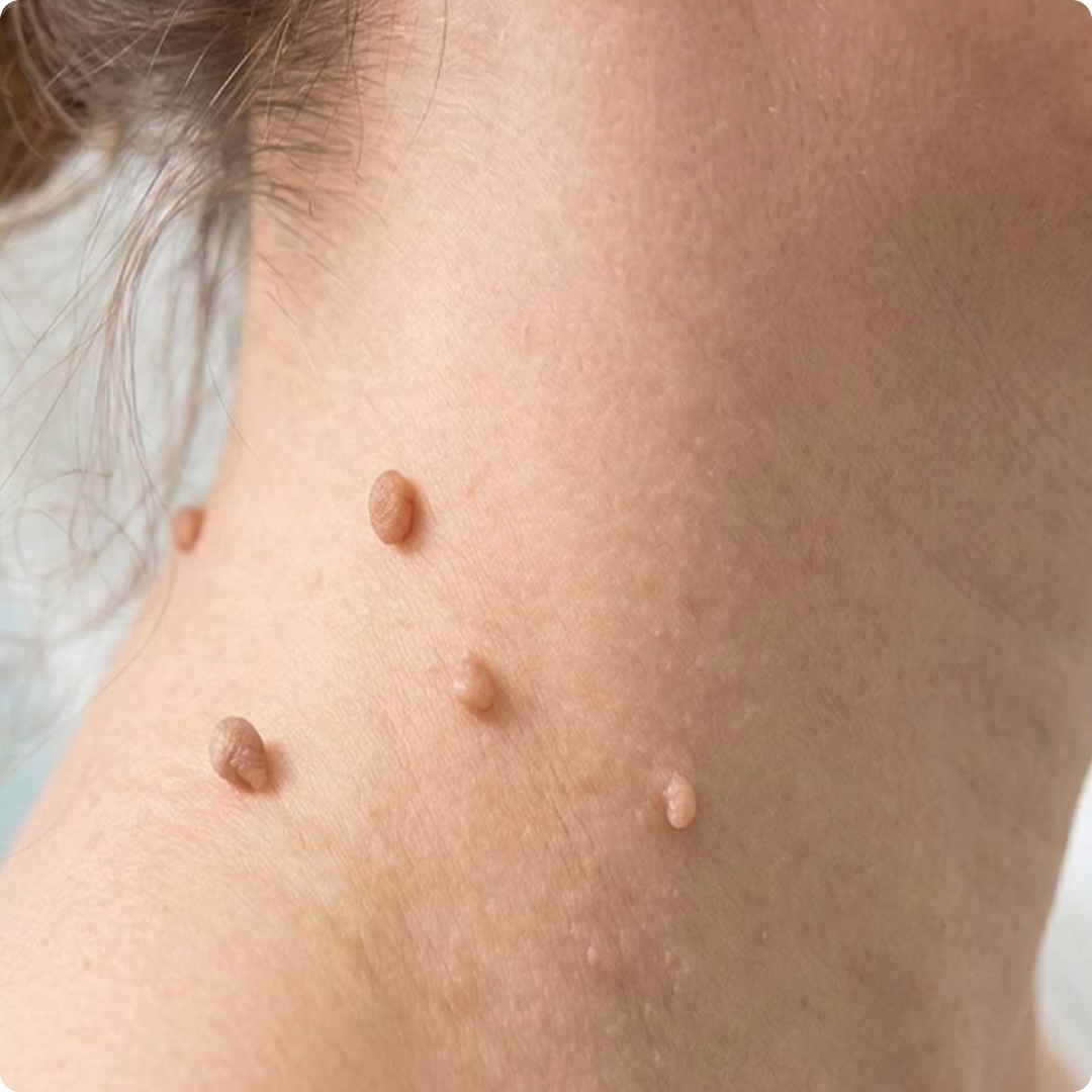 skin tag removal 