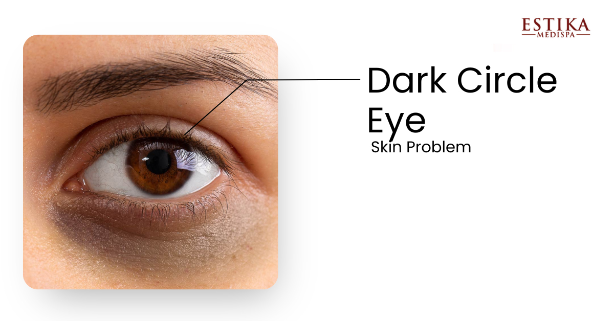 under eye treatment for dark circles
