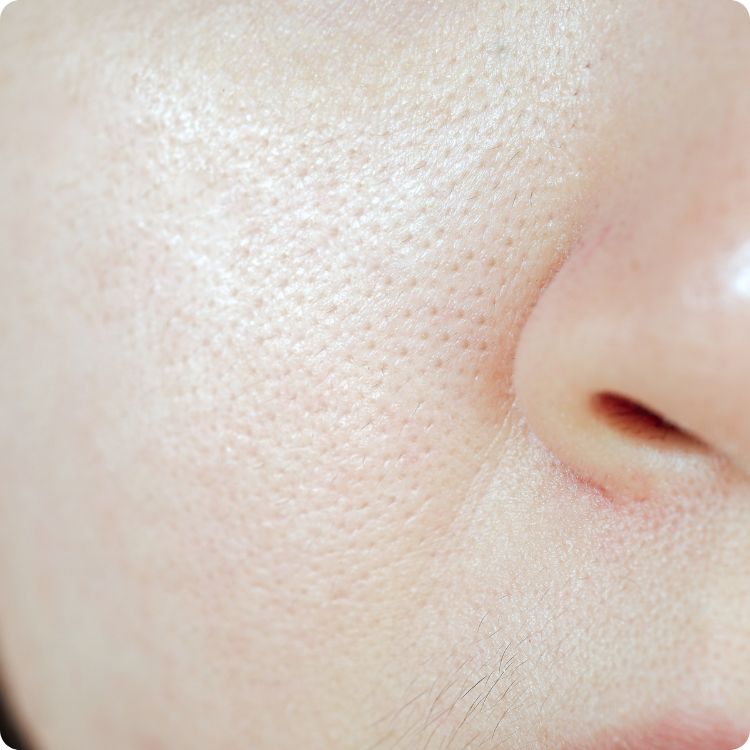open pores treatment