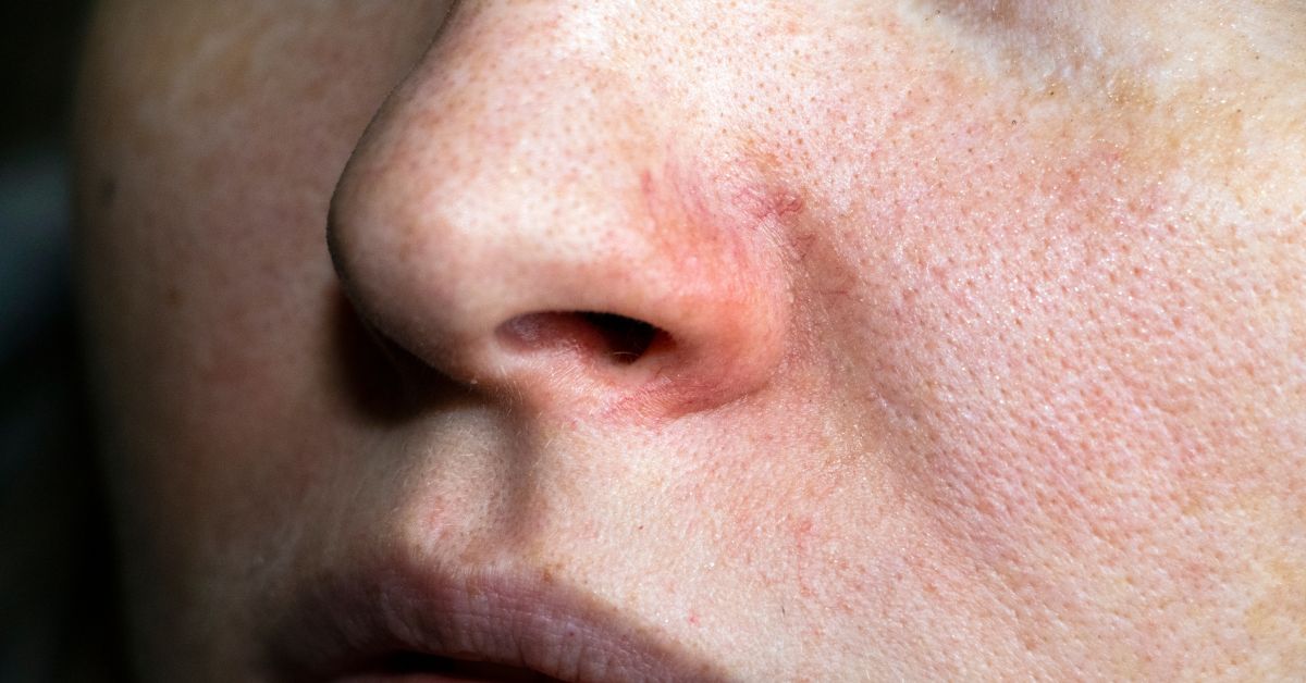 open pores treatment