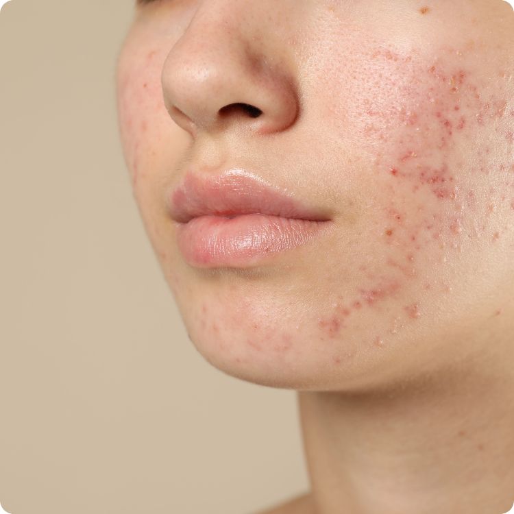 type of acne scars