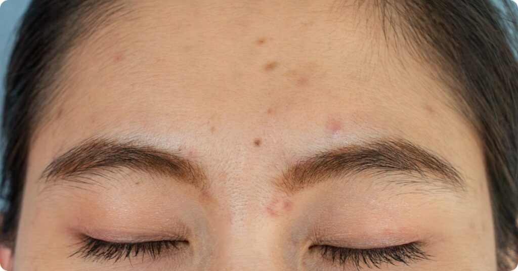 types of acne scars