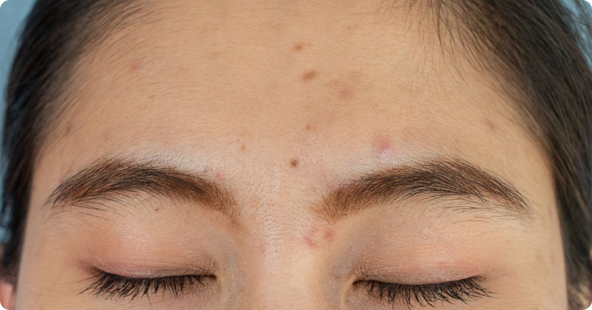 types of acne scars