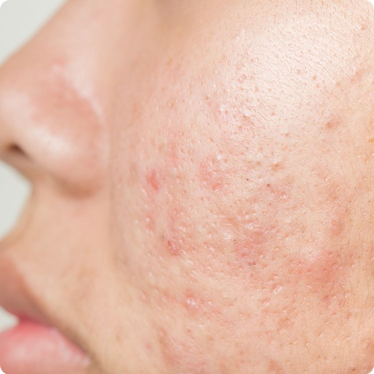 Estika Medispa dermapen treatment