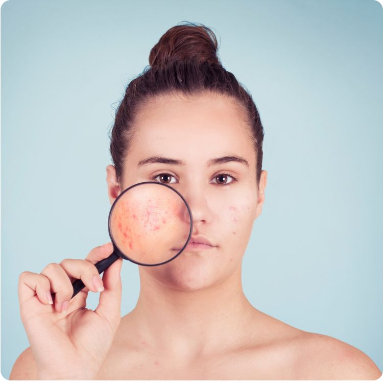 Estika Medispa dermapen treatment