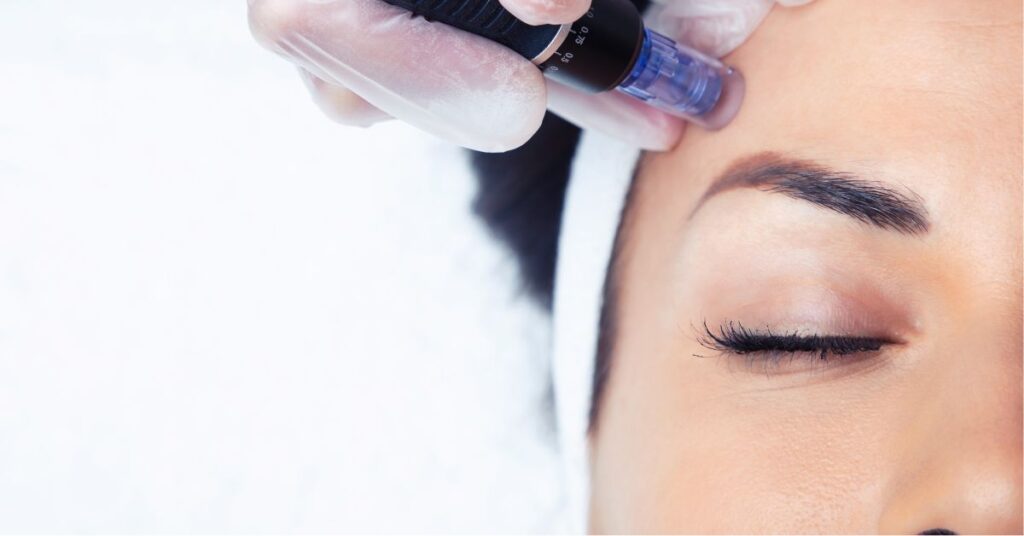 rawatan dermapen treatment di estika medispa