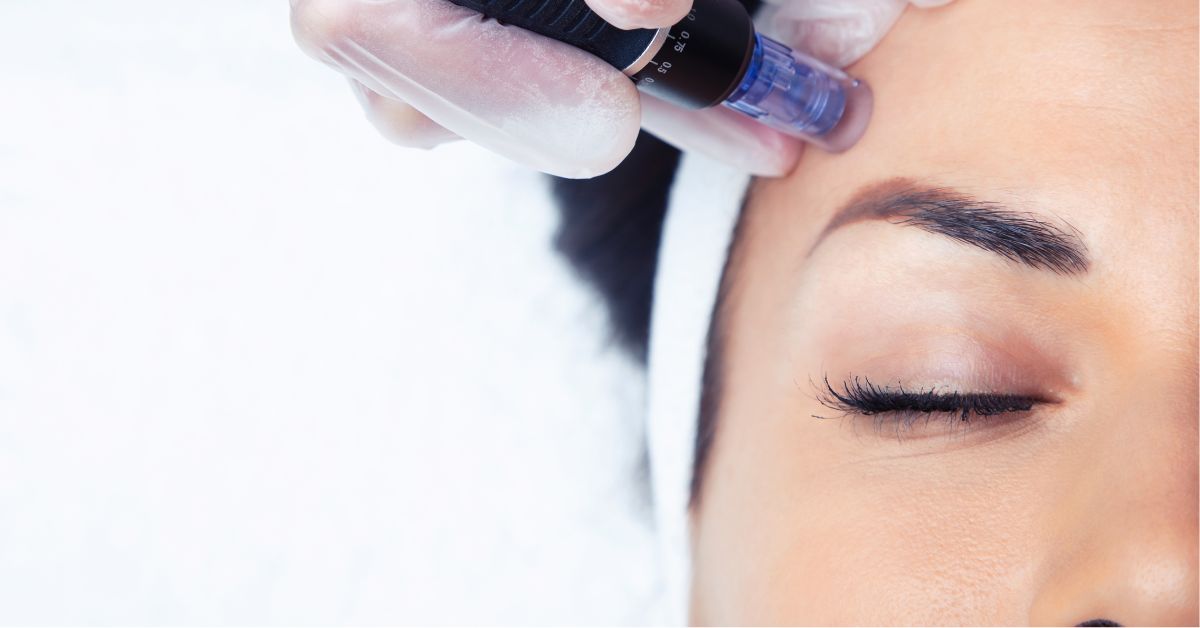 Estika Medispa rawatan dermapen treatment di estika medispa
