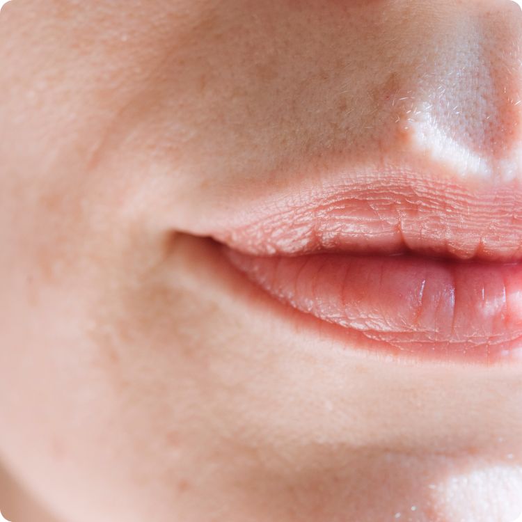 Estika Medispa laser bibir