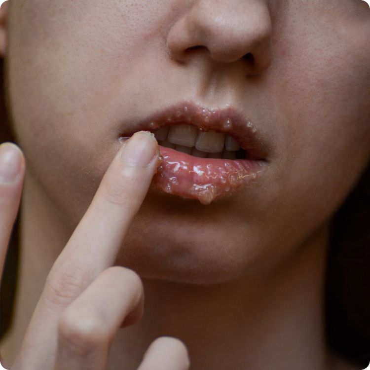 Estika Medispa laser bibir