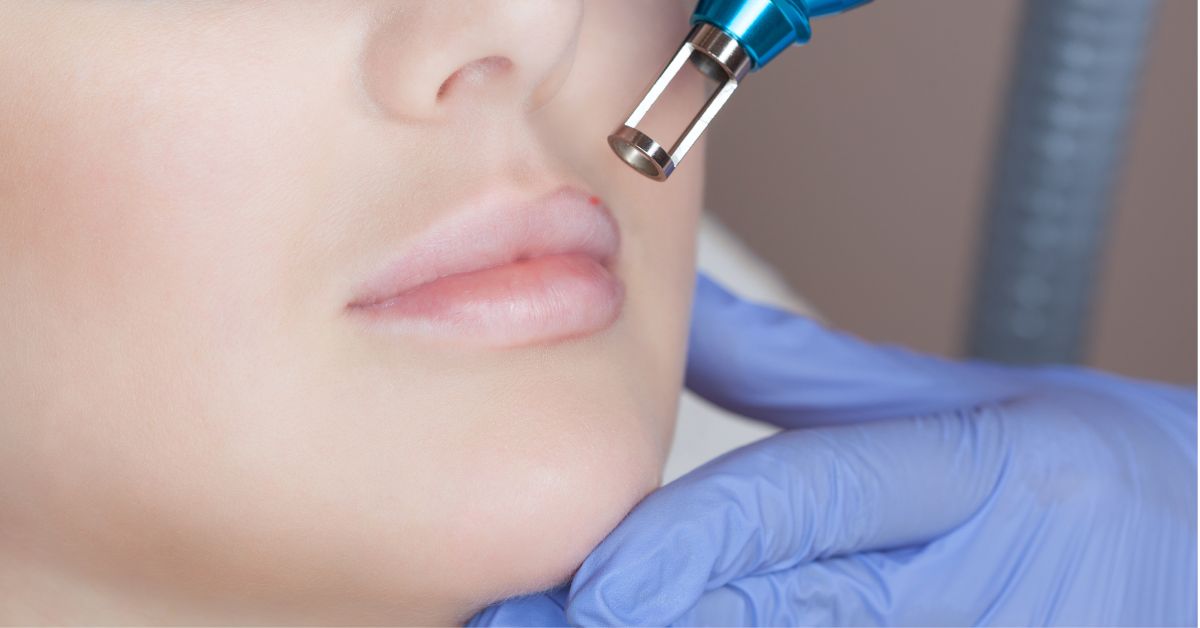Estika Medispa laser bibir