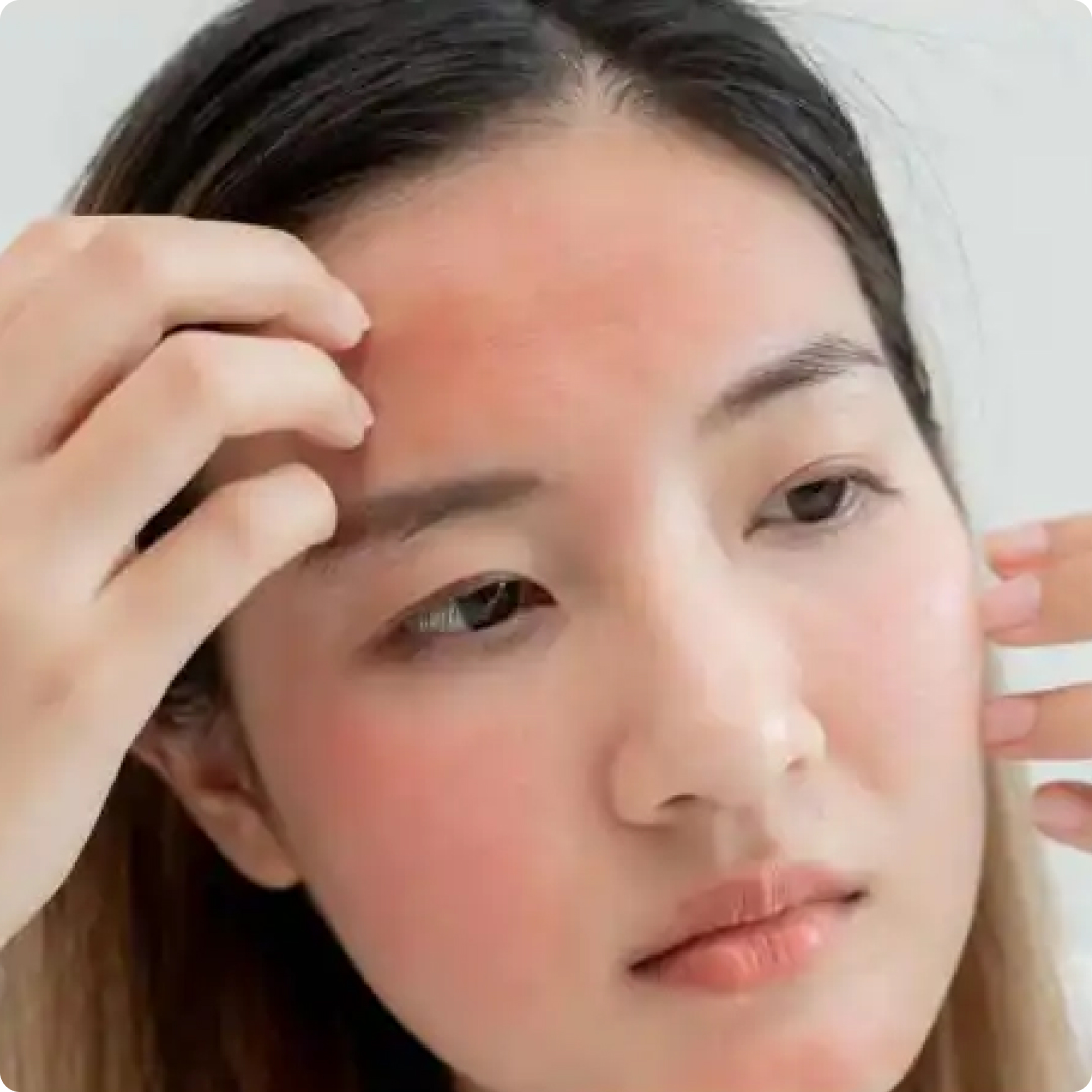 kesan sunburn di muka