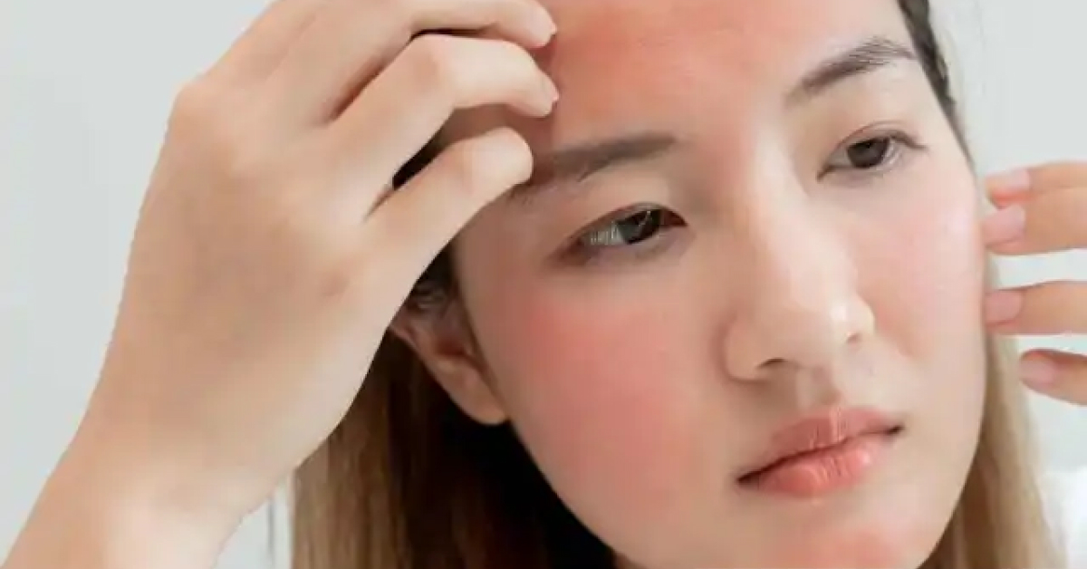 kesan sunburn di muka