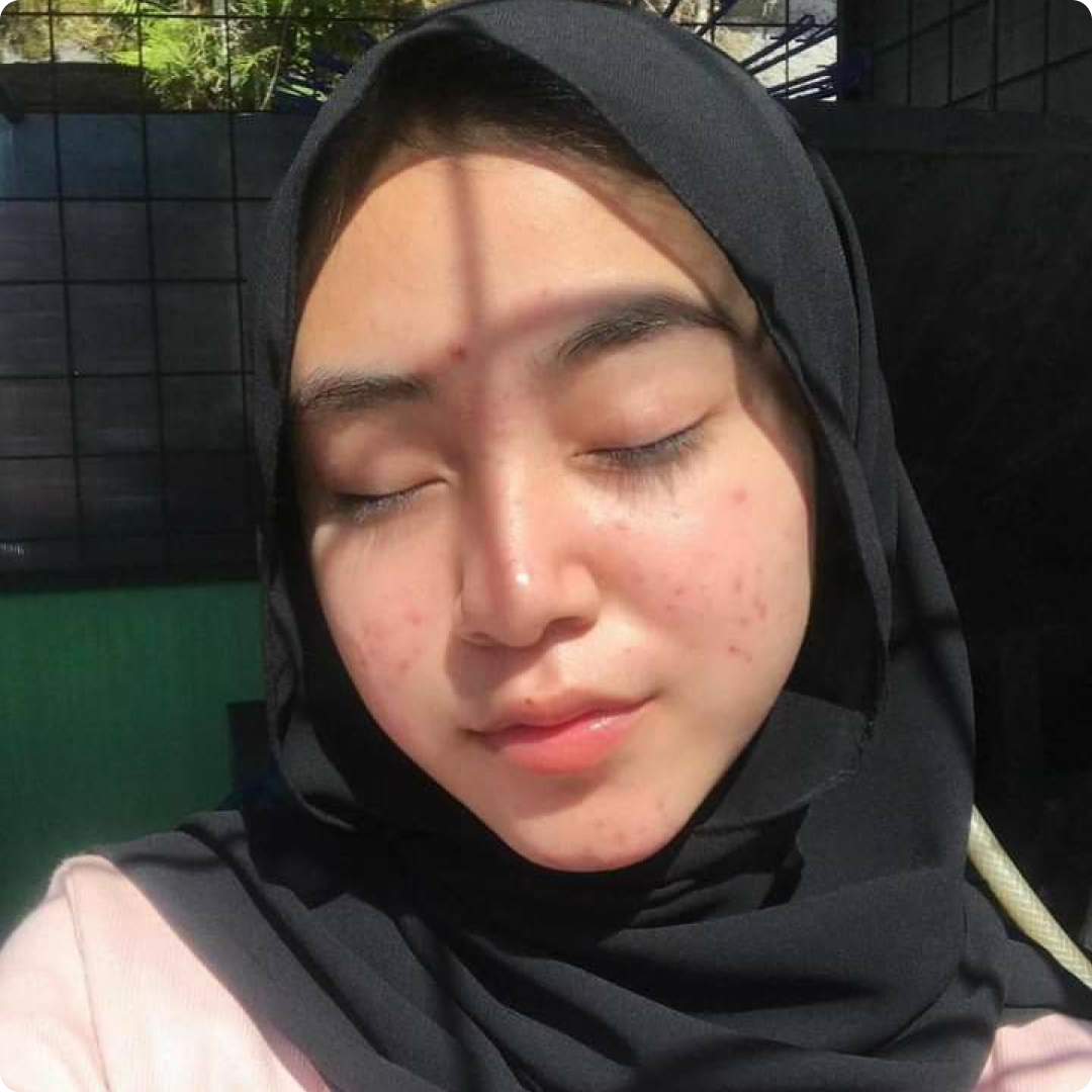 jerawat sebelum period