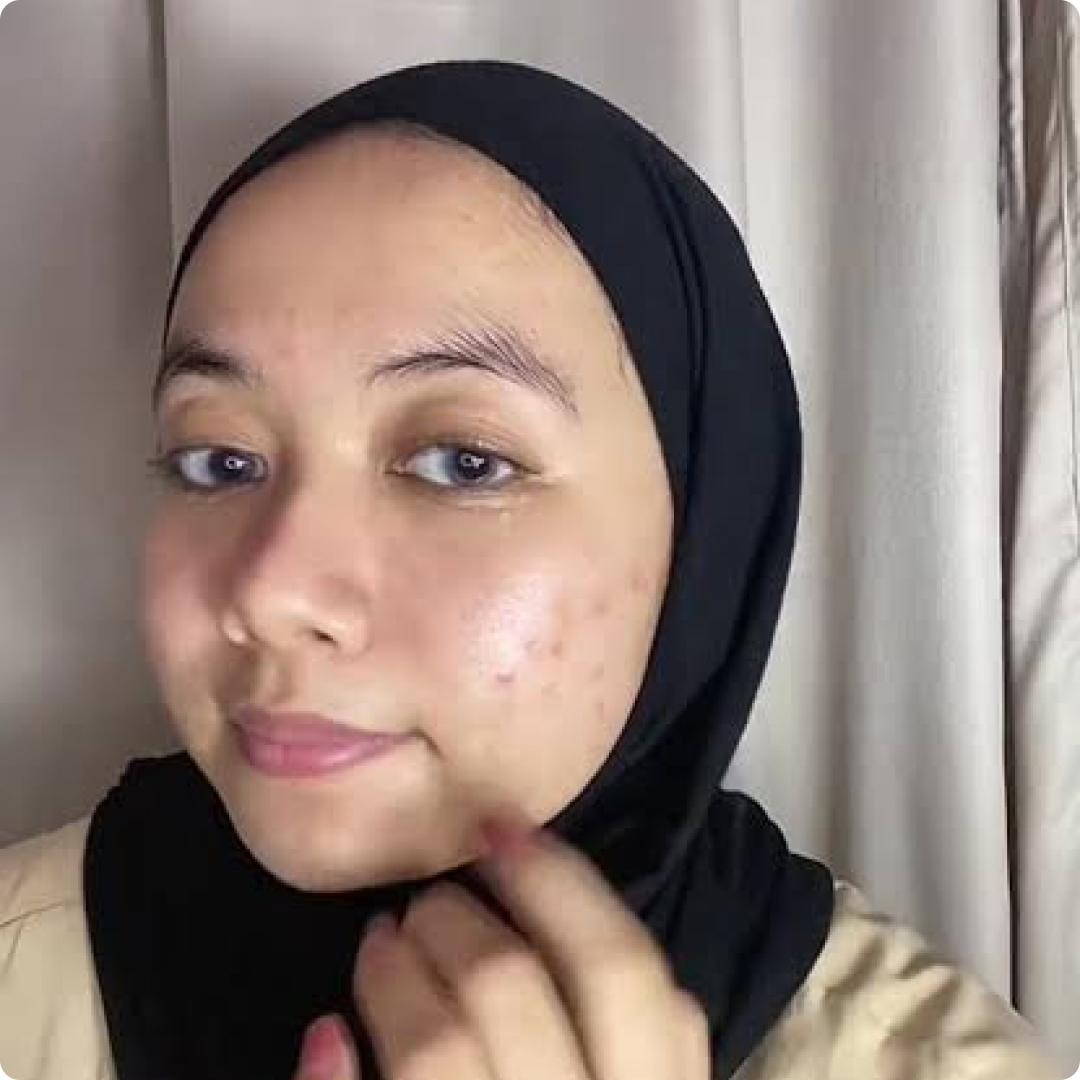 jerawat sebelum period