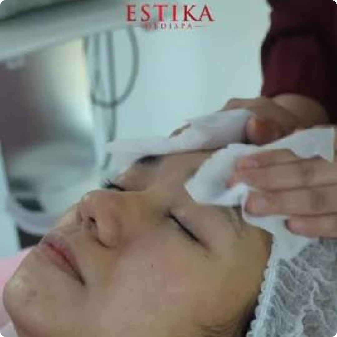 rawatan facial jerawat period estika medispa
