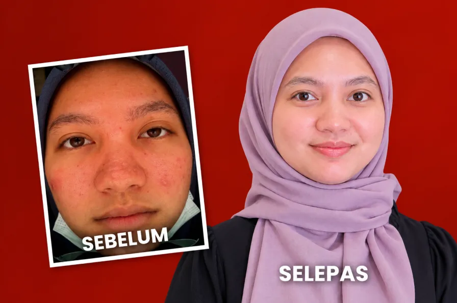Estika Medispa nisa ui asyiah estika medispa testimonial
