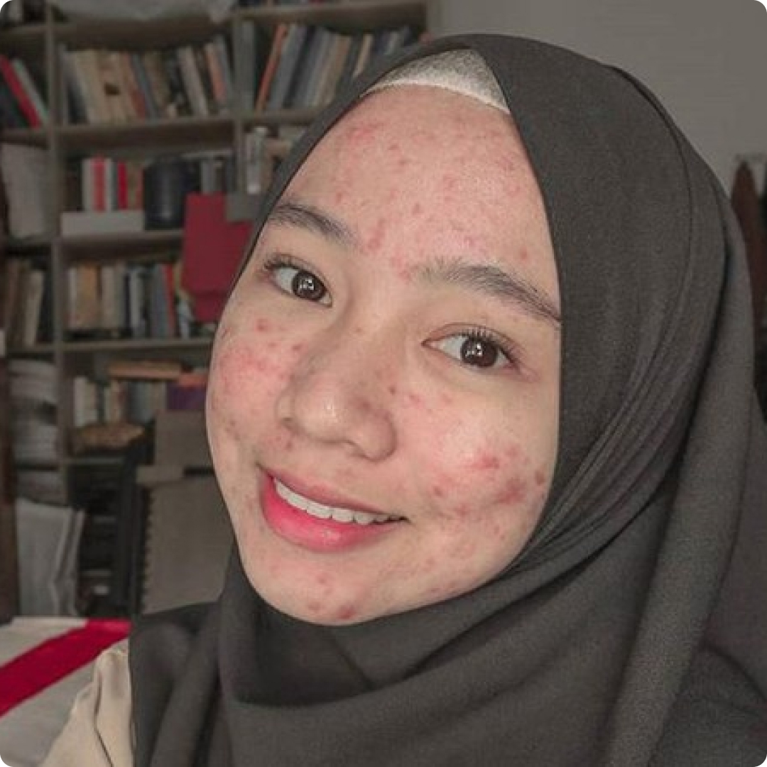 penyakit kulit jerawat