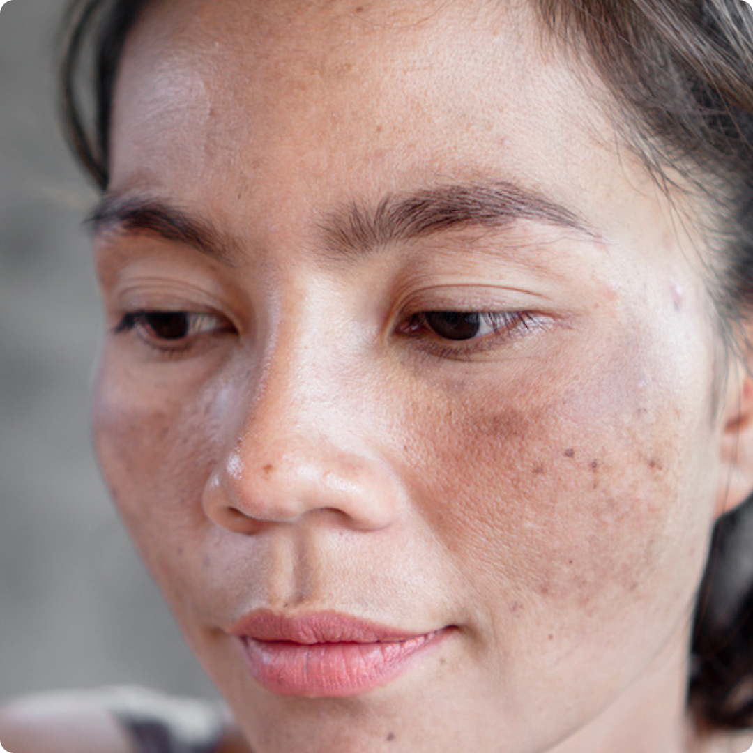 penyakit kulit melasma