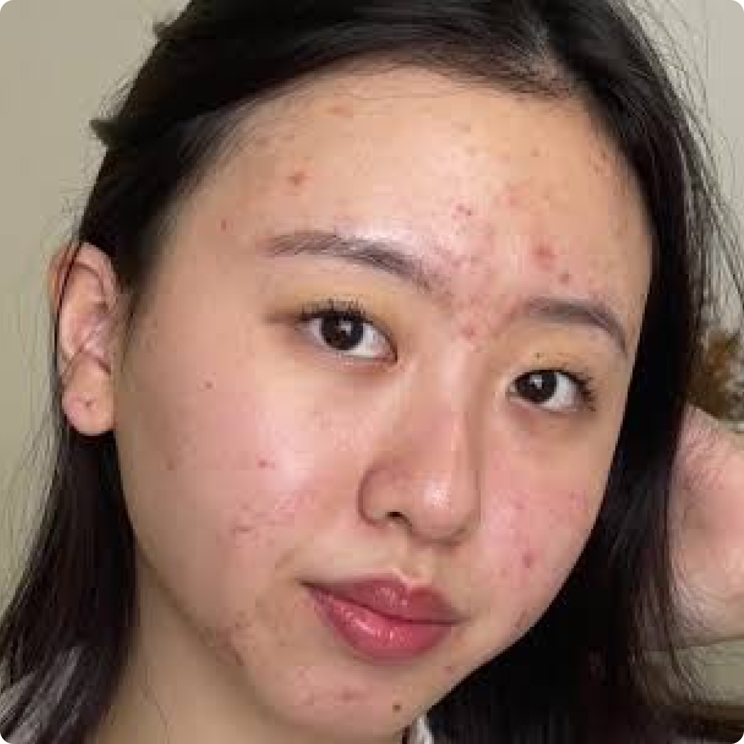 penyakit kulit rosacea