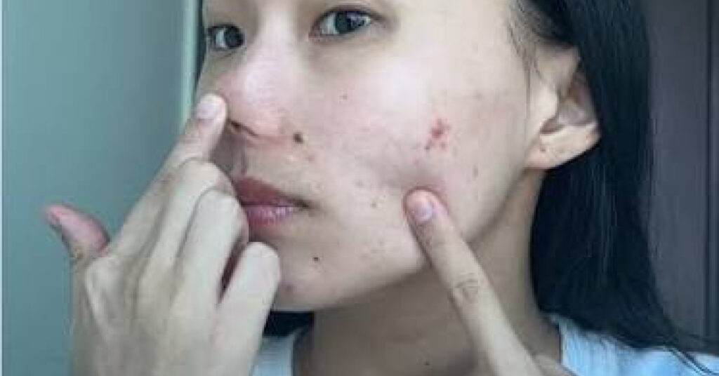 muka gata selepas facial